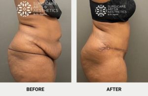 Contouring the abdomen with tummy tuck and liposuction before and afetr photos