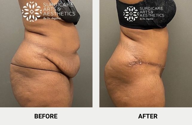 Abdominal contouring with tummy tuck and liposuction before and afetr photos