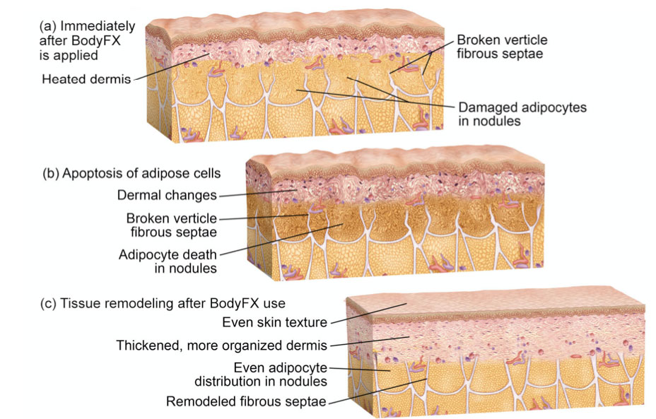 Non-Invasive Body Contouring BodyFX