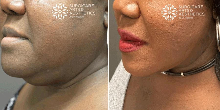 Face fat removal with FaceTite