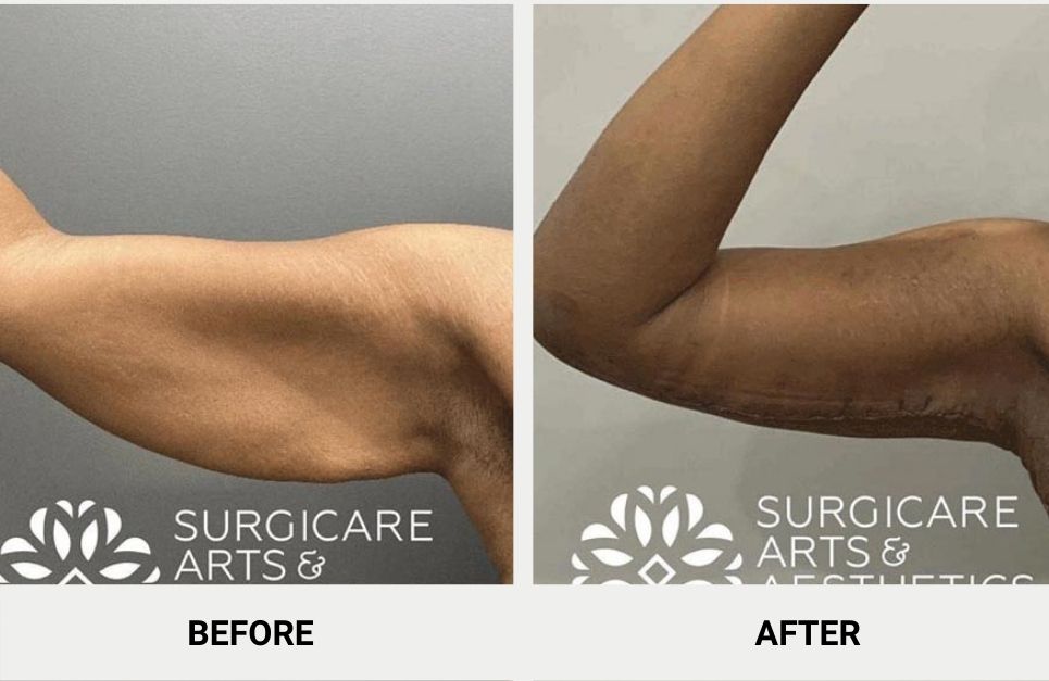 arm lift surgery results