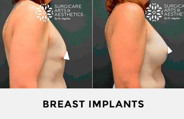 Photos before and after BREAST IMPLANTS