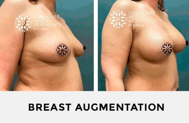 Photos before and after BREAST AUGMENTATION