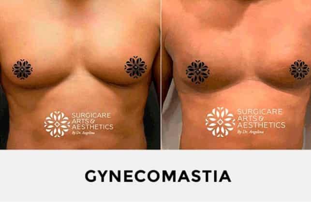 Photos before and after GYNECOMASTIA