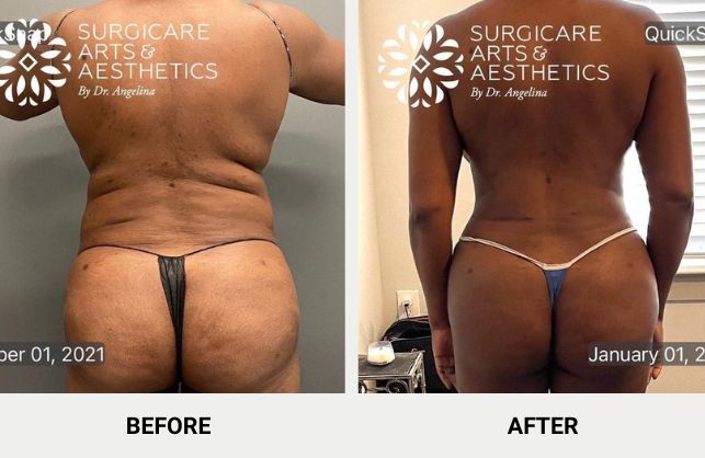 before and after BBL and Liposuction