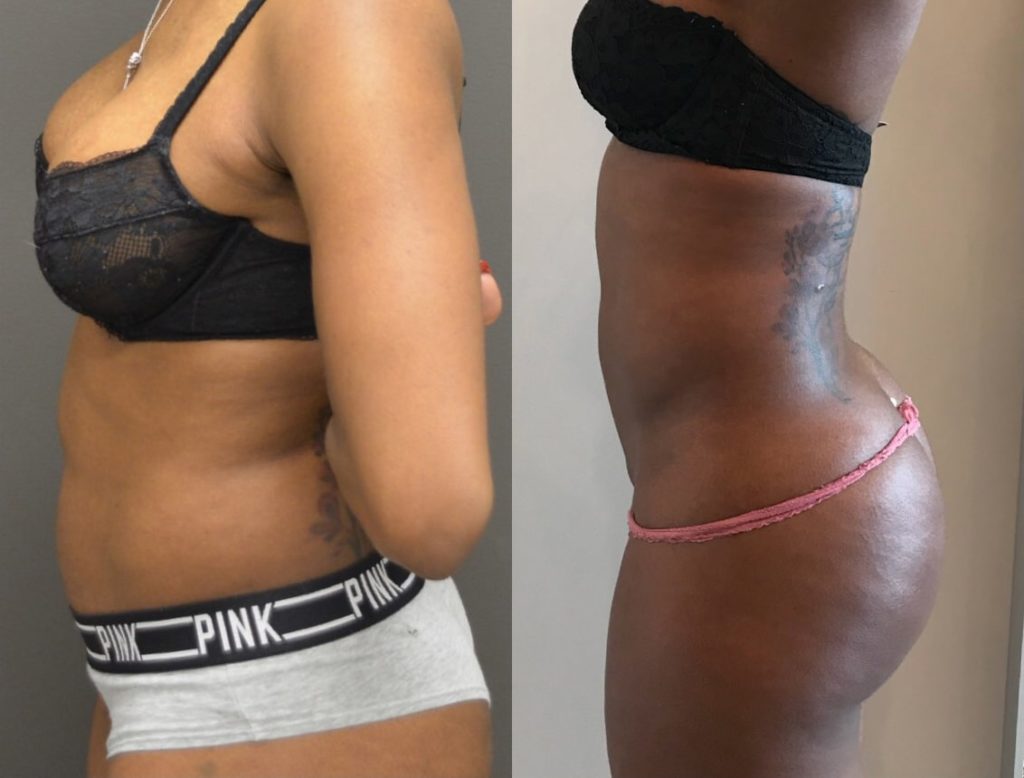 BodyTite Before And After - Tummy - side view