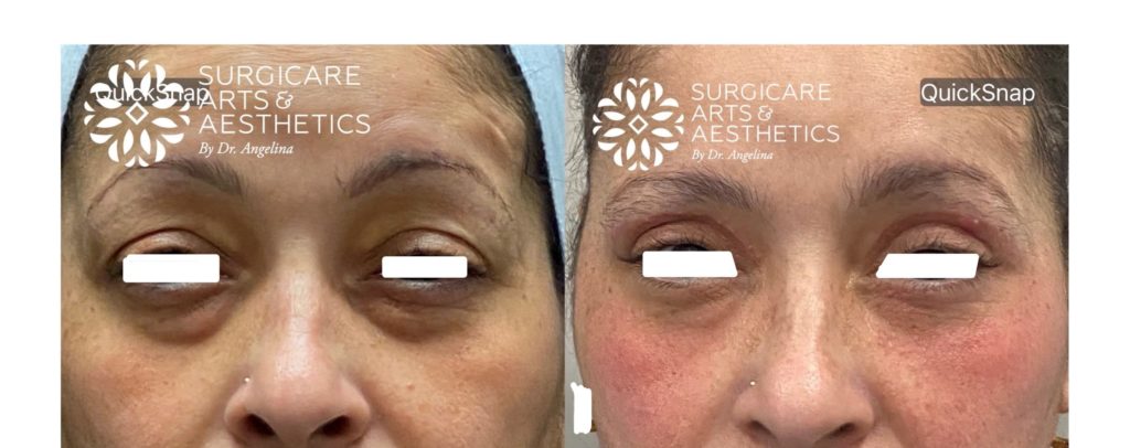 Before and after blepharoplasty