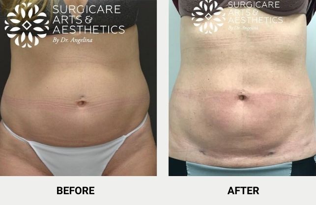 Non-invasive fat removal with BodyTite before and after photos