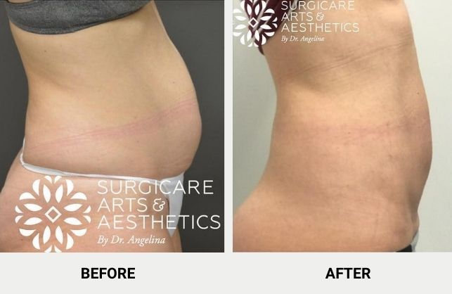 Non-invasive fat removal with BodyTite before and after photos