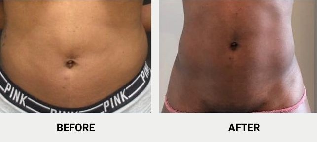 Non-invasive fat reduction with BodyTite before and after photos