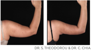 bodytite procedure: before and after