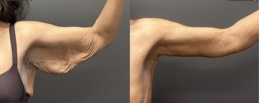 Brachioplasty results after significant weight loss - left arm