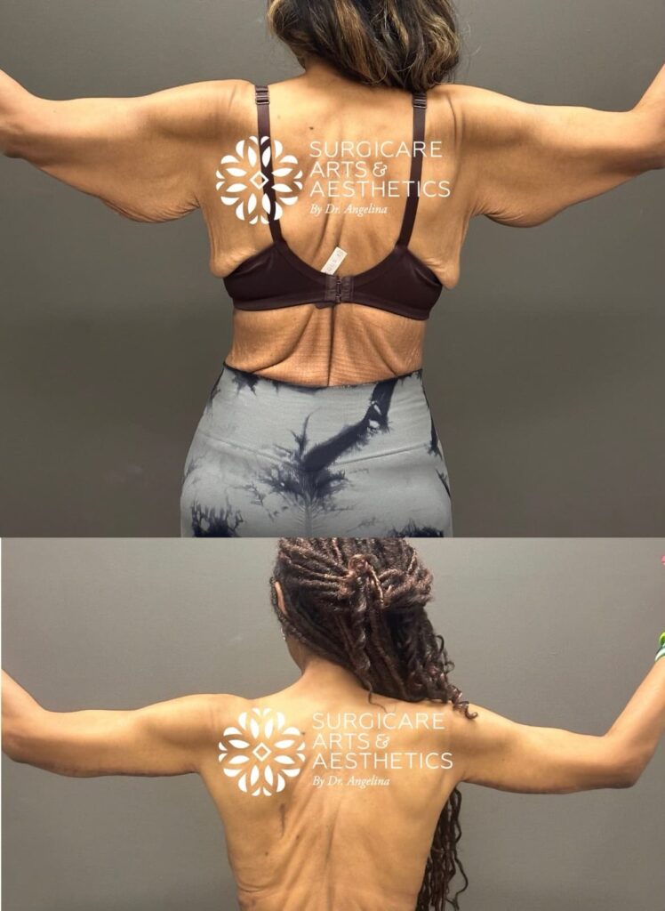 Brachioplasty results after significant weight loss - back