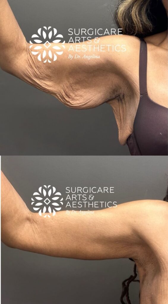 Brachioplasty results after significant weight loss - right arm