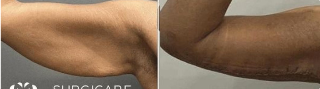 arm lift before and after