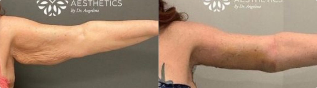 Brachioplasty Before And After Surgery