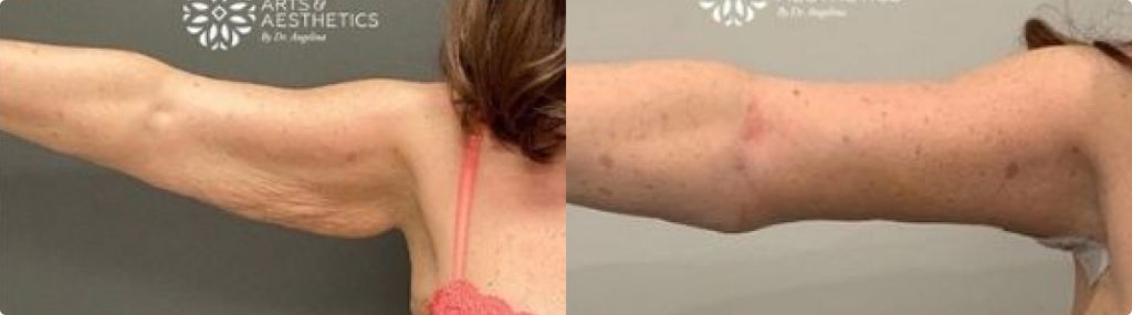 arm lift before and after