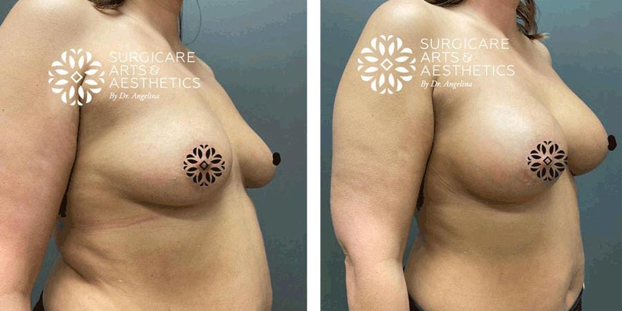 before and after breast implants