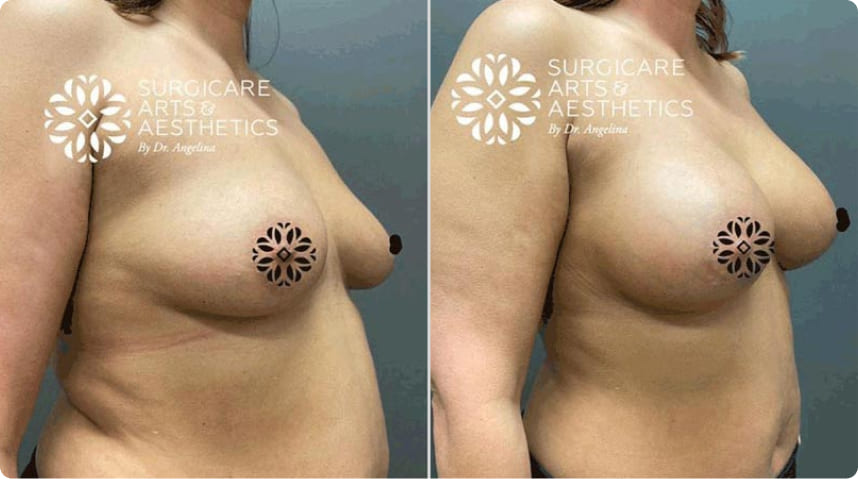 Before And After Breast Augmentation