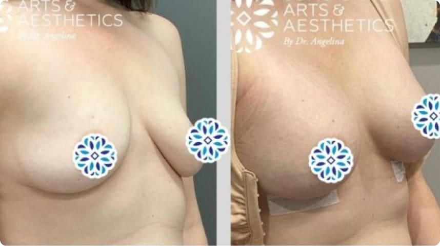 Before And After Breast Augmentation