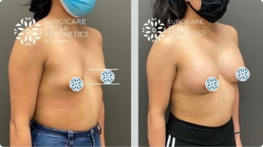 Before And After Breast Augmentation