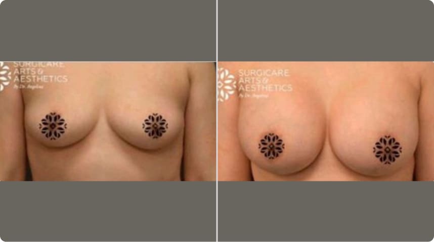Before And After Breast Augmentation