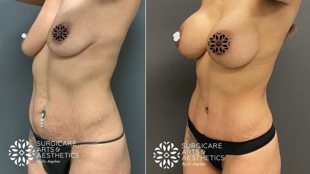 Before and after breast augmentation with 400 ccs implants