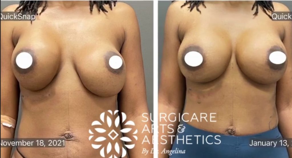 Breast implant revision before and after.