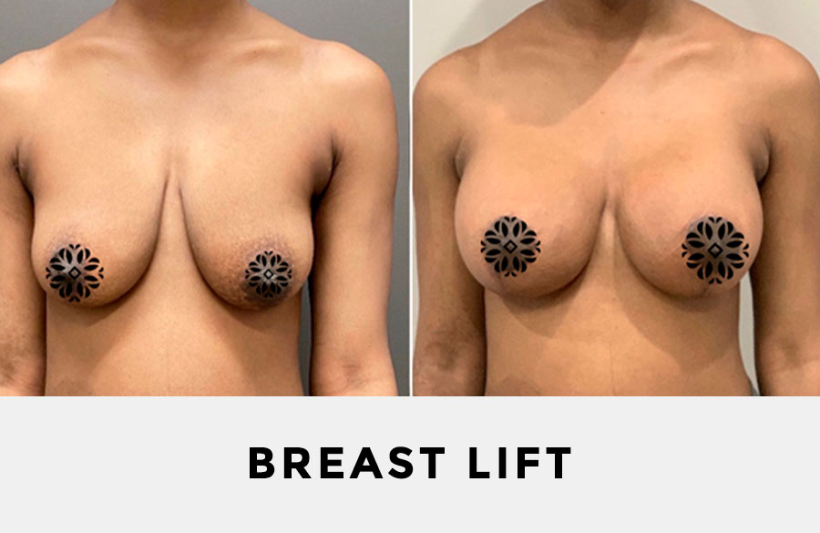 breast lift