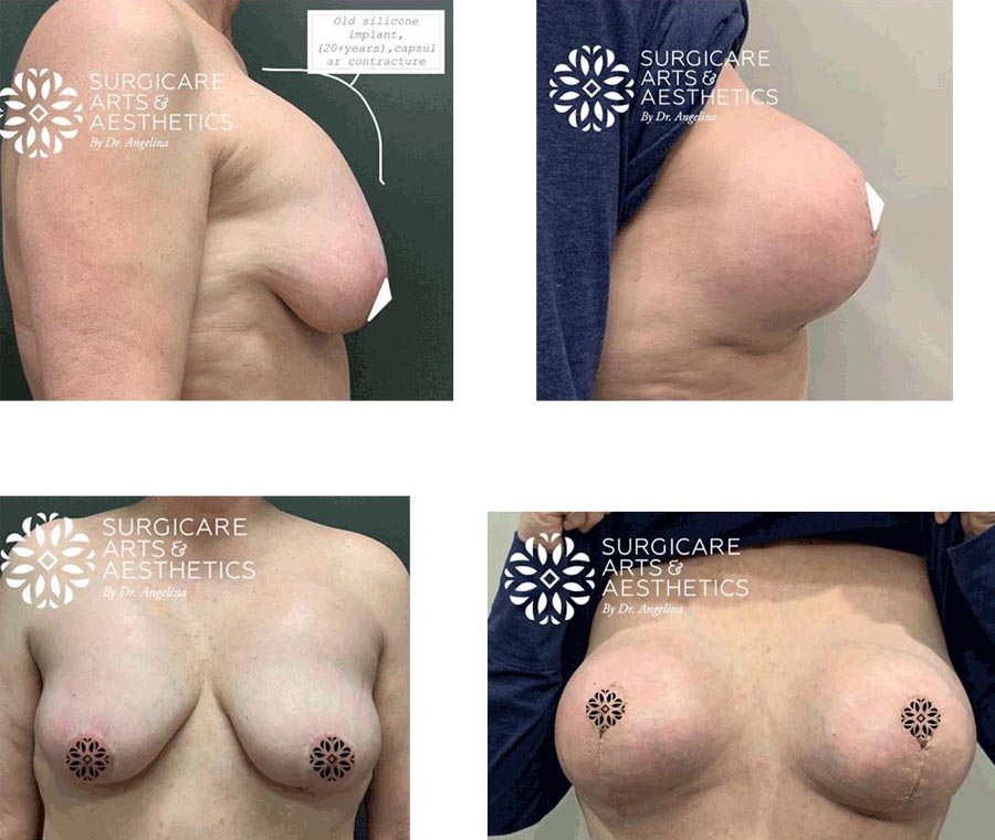 Before And After Breast Implant Revision with Breast Lift