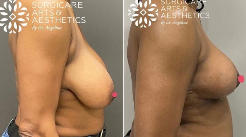 Before And After Breast Lift