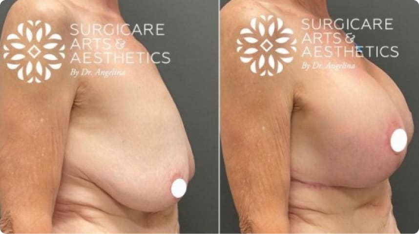 Before And After Breast Lift