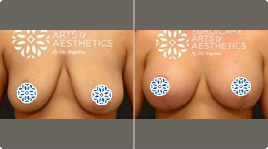 Before And After Breast Lift