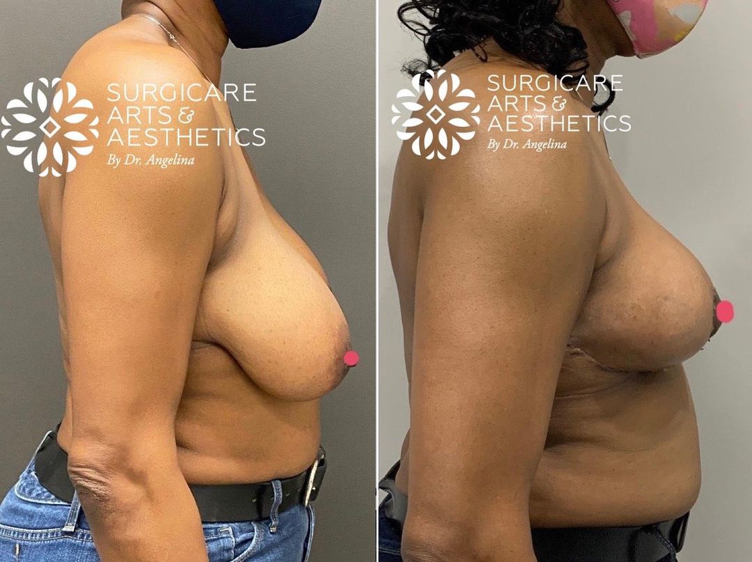 breast lift without implants before and after