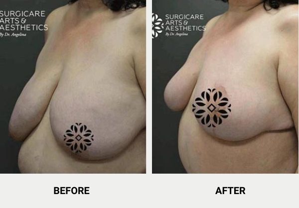 breast reduction before and after