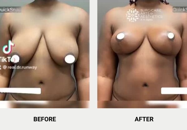 SBreast reduction and lift before and after