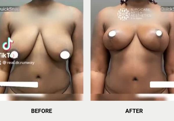 Scarring after breast reduction surgery