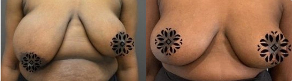 These Breast Reduction Results