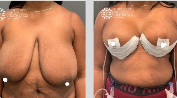 Breast reduction and lift before and after