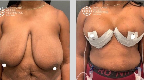 Breast reduction healing process