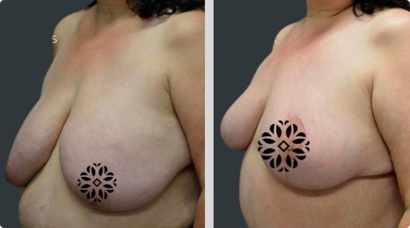 Before and after breast reduction surgery