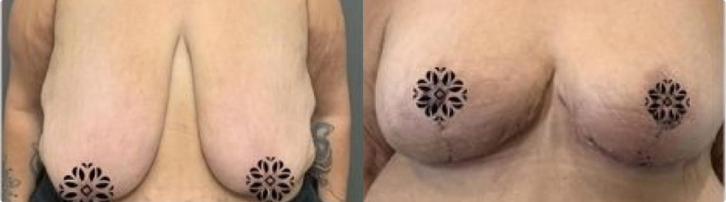 Before and After Breast Reduction and Lift