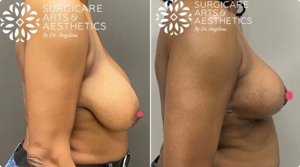 Before And After Pictures of Breast Lift and Breast Reduction