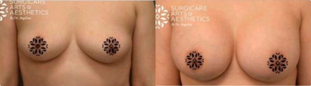 Before And After Breast Augmentation With Implants