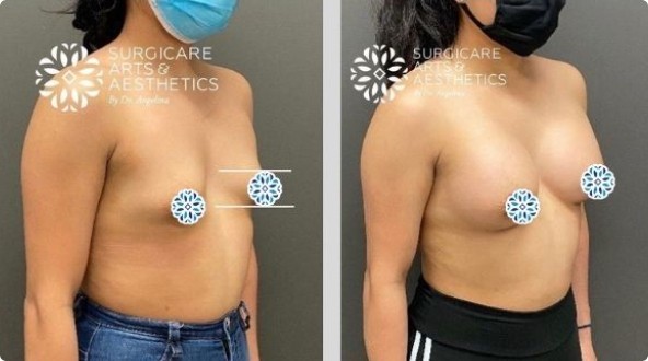 Before and after small breast implants