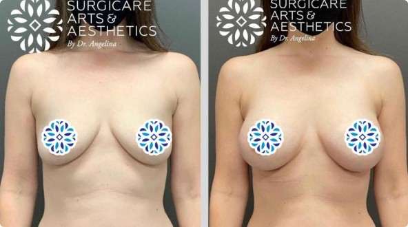 Breast Augmentation Before & After With Increased Cup Size