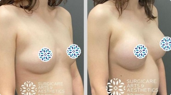 This Breast Augmentation Before & After Shows Added Volume In Breasts That Were Deflated