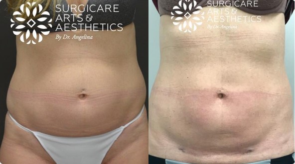 Bodytite Stomach Before And After Pictures