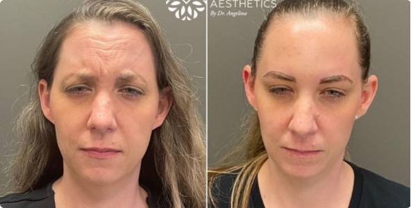 Forehead Botox Before And After