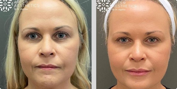 Botox Lip Flip Before And After